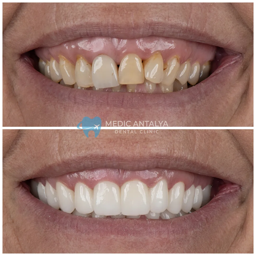 Dental İmplant Ã¶nce