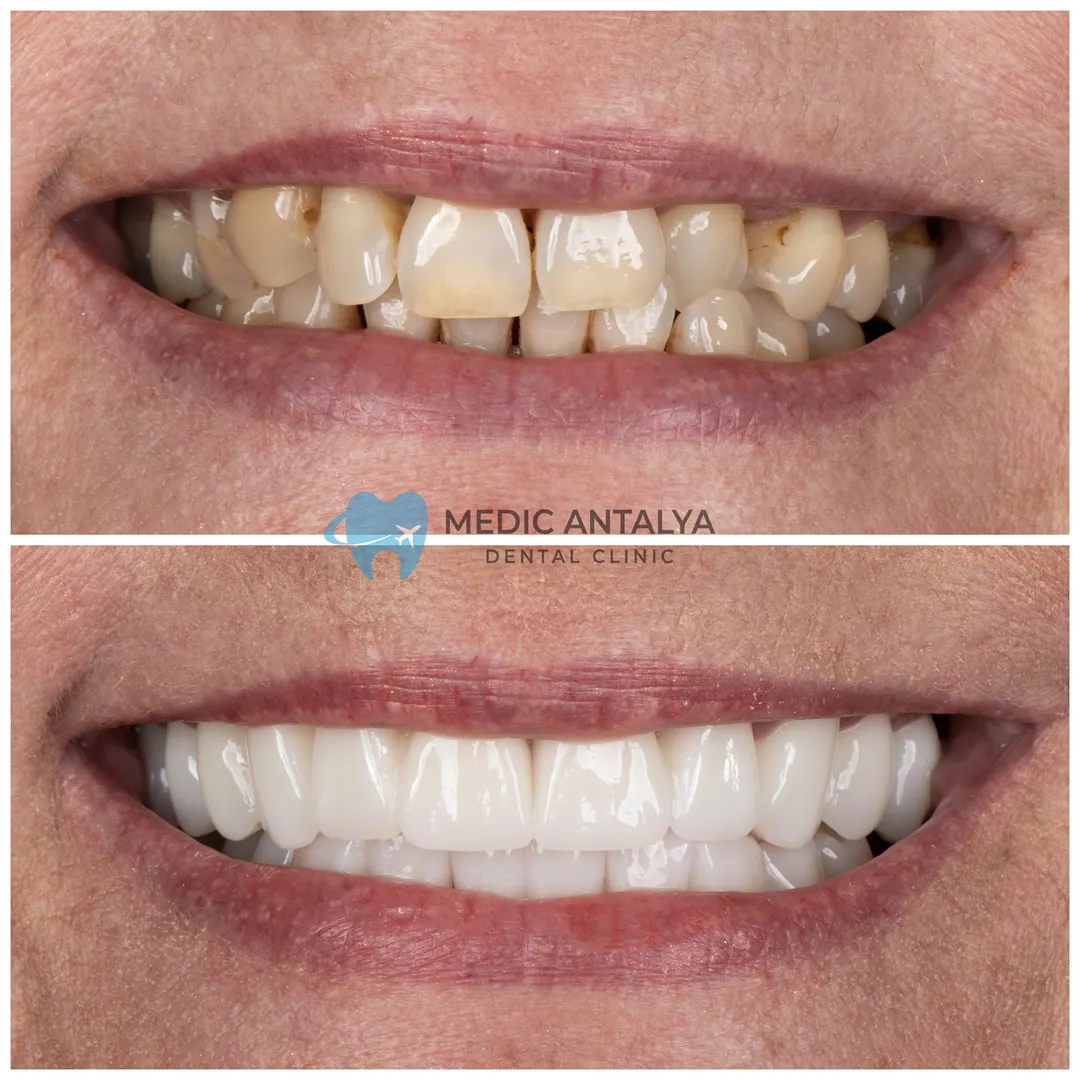 Dental İmplant sonra
