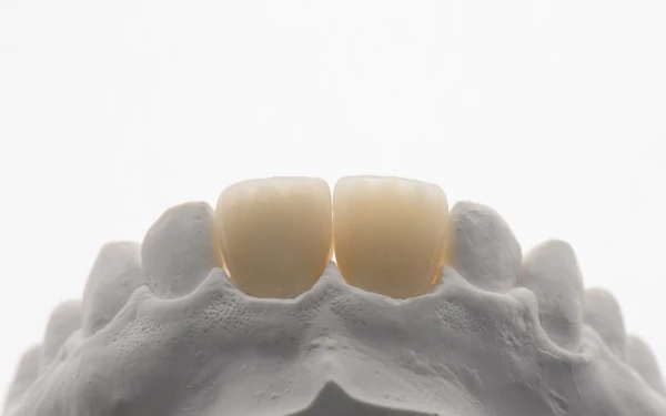 Emax Crowns