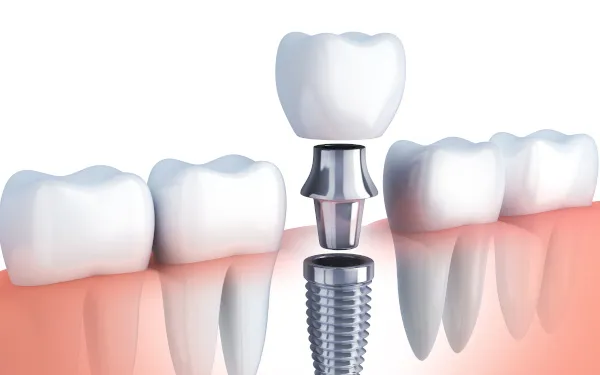 Dental Implants