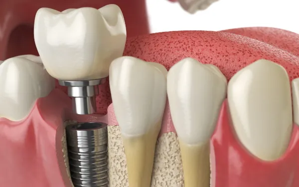 Dental Implants 2