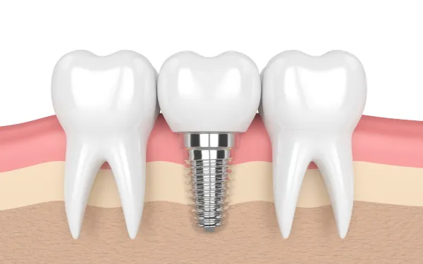 Dental Implants 3