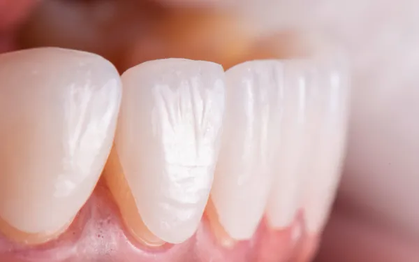 Laminate Veneers