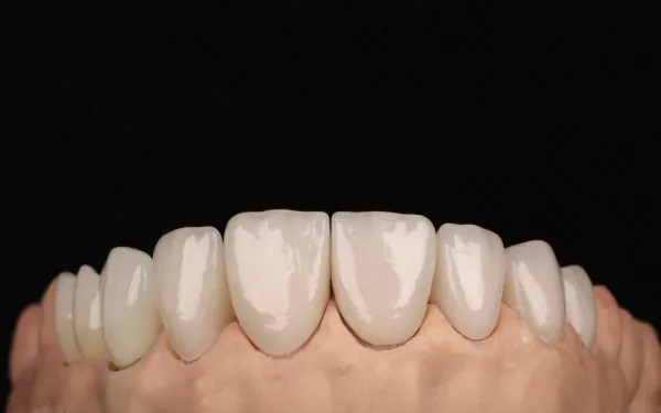 Zirconium Crowns